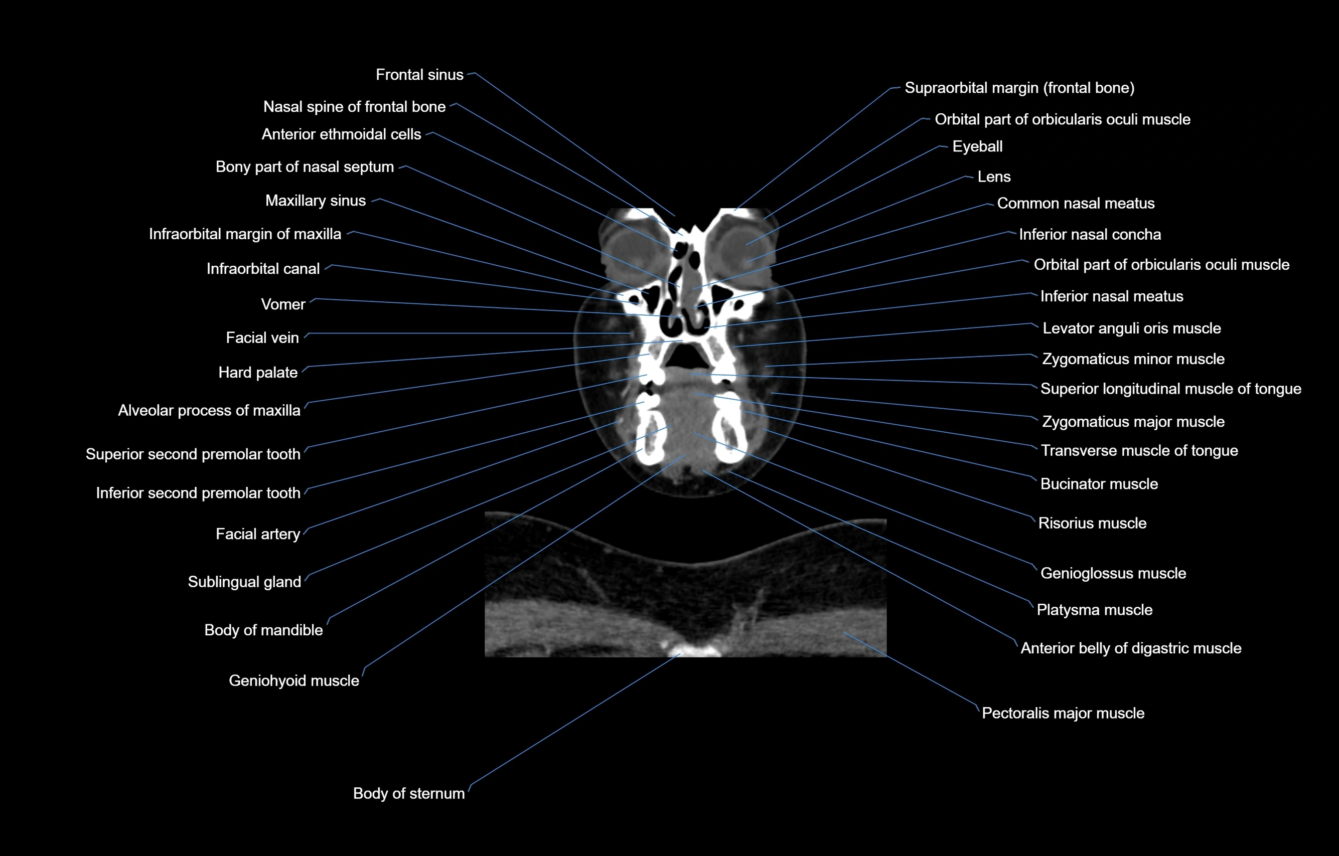 CT Neck coronal  cross sectional anatomy labelled 3D  radiology  image-00013.webp